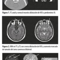Técnica de abordaje mixto en fistula carotido-cavernosa espontánea bilateral: presentación de un caso