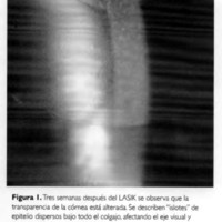 LASIK y superficie ocular: crecimiento epitelial bajo el colgajo