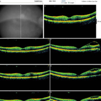 Figura 17. OCT macular OD. Se observa arquitectura macular normal, sin zonas de hiporrefringencia tanto a nivel intrarretinal como subretinal (EM 264 μm).