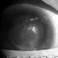 Queratitis por Acanthamoeba en un Paciente Usuario de Solución Multipropósito de Limpieza de Lentes de Contacto: Primer Caso en Argentina.