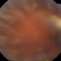 Linfomas intraoculares