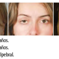 Figura 14. A los 20 años. <br />
Figura 15. A los 27 años. <br />
Figura 16. Ptosis palpebral.