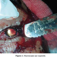 Figura 1. Macroscopía ojo izquierdo.