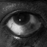 Figura 2. Melanocistosis conjuntival.