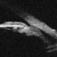 Figura 3. Desprendimiento de cuerpo ciliar por UBM.