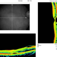Figura 12. OCT macular OD. Se observa una gran disminución de la hiporrefringencia subretinal. El EM disminuye a 263 μm.