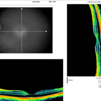 Figura 8. OCT macular OI. Se observa arquitectura macular normal. EM 250 μm.