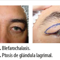 Figura 22. Blefarochalasis.<br />
Figura 23. Ptosis de glándula lagrimal.