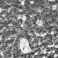Figura 3. Tumor constituido por células neoplásicas con marcada actividad mitótica dispuestas en estructuras tubulares y varias capas celulares.