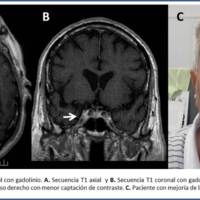 Figura 2. RMN de cerebro control con gadolinio. A) Secuencia T1 axial y B) Secuencia T1 coronal con gadolinio, muestran disminución del engrosamiento del seno cavernoso derecho con menor captación de contraste. C) Paciente con mejoría de la paresia del III par craneal.