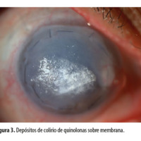 Figura 3. Depósitos de colirio de quinolonas sobre membrana.