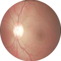 Figura 4. Reabsorción de hemorragia con edema circundante.