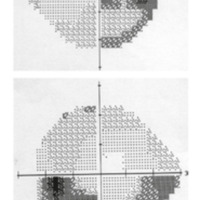 Figura 1. Campos visuales Humphrey: en la escala de grises se aprecian<br />
los defectos escotomatosos. OD: escotoma cerca del área de fijación y<br />
aumento de la mancha ciega. OI: escalón nasal profundo, aumento de la<br />
mancha ciega y escotoma de Bjerrum inferior.