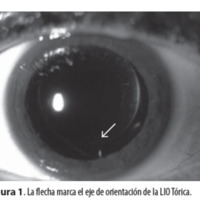 Figura 1. La flecha marca el eje de orientación de la LIO Tórica.
