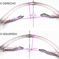 Figura 5. OCT Visante a los 10 días de tratamiento con hipotensores. Apertura angular.