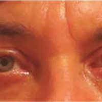 Control postoperatorio a las 6 semanas de reposición grasa, blefaroplastia superior y pexia de cola de ceja.
