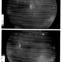 Metástasis coroidea bilateral: relación con el cáncer de mama