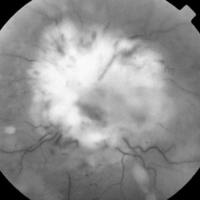 Papilitis y pseudohipopion en linfoma intraocular primario