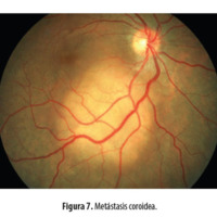 Figura 7. Metástasis coroidea.