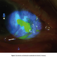 Figura 5. Ojo derecho con disminución considerable de la tinción (7 semanas).