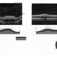 Figura 5. OCT papilar que muestra edema papilar (izquierda) y su resolución posterior (derecha).
