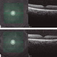 Efectos secundarios del tratamiento de melanoma metastásico con dabrafenib y trametinib: uveítis anterior aguda