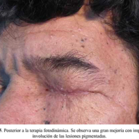 Figura 5. Posterior a la terapia fotodinámica. Se observa una gran mejoría con importante involución de las lesiones pigmentadas. 