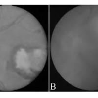 Prevalencia y factores de riesgo asociados con toxoplasmosis ocular en la zona centroeste de la provincia de Misiones, Argentina 