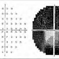 Neuropatía óptica isquémica anterior tras prostatectomía radical laparoscópica 