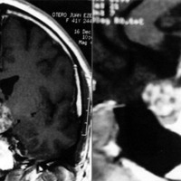 Figura 2. Resonancia magnética nuclear (RMN) de cerebro y región selar, cortes coronal y sagital (T1 con gadolinio), donde se evidencia masa en región selar y supraselar con compresión de quiasma óptico y realce heterogéneo del contraste.