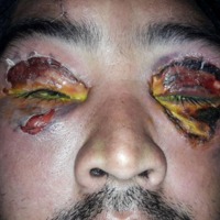 Figura 1. Hematoma y edema bipalpebral bilateral con lesiones costroulcerativas en región frontal. Herida cortante suturada.