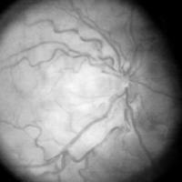 Microftalmos posterior con pliegue papilomacular: informe de un caso