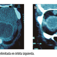 Figura 2 a y b. TC de órbitas coronales: lesión bien delimitada en órbita izquierda.