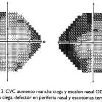 Fig. 11. Caso 3. CVC aumento mancha ciega y escalón nasal OD; aumento de la mancha ciega, defector en periferia nasal y escotomas temporales, OI.