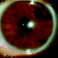 Figura 4. Regresión de las lesiones en iris después de la radioterapia.