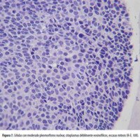Figura 7. Células con moderado pleomorfismo nuclear, citoplasmas débilmente eosinofílicos, escasas mitosis (H-E. 10X).