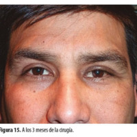 Figura 15. A los 3 meses de la cirugía.