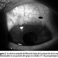 Figura 3. Se observa ampolla de filtración luego de la extracción de la sutura liberalizable en un paciente del grupo en estudio (15° día posquirúrgico).