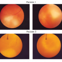 Figura 1. Pacientes 1 y 2 con extensas placas coriorretinales necrotizantes bilaterales.