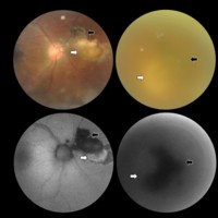 Figura 3. Caso 33 (izquierda superior e inferior): retinitis clásica. La AFF define mejor el componente activo hiperautofluorescente (flecha blanca) de la lesión inactiva satélite hipoautofluorescente (flecha negra). Caso 2 (derecha superior e inferior): retinitis clásica con intensa turbidez vítrea. La AFF pone de manifiesto la cicatriz satélite hipoautofluorescente (flecha negra) adyacente a lesión activa (flecha blanca), difícil de identificar a la oftalmoscopía.