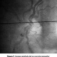 Figura 2. Imagen ampliada del asa vascular prepapilar.