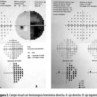 Figura 2. Campo visual con hemianopsia homónima derecha. A: ojo derecho. B: ojo izquierdo.
