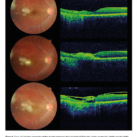 Figura 4. Caso 31. Superior: compromiso atrófico de retina temporal a fóvea por lesión de TO inactiva. Centro: reactivación, retinitis macular satélite. Engrosamiento retinal hiperreflectivo con sombra acústica y engrosamiento de hialoides adherida. Inferior: membrana epirretinal, desprendimiento hialoideo y adelgazamiento retinal con esquisis. En sector nasal de mácula: edema en capa nuclear externa, compromiso de segmentos externos de fotorreceptores y EPR; plegamiento de superficie interna.