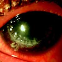 Figura 2. Signos derechazo estromal a los 19 días postoperatorios.Edema estromal, vasos estromales, hiperemia conjuntival e infiltración de puntos.