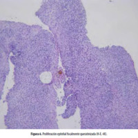 Figura 6. Proliferación epitelial focalmente queratinizada (H-E. 4X).