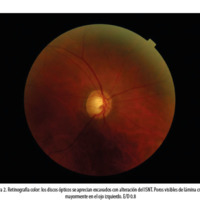 Figura 1. Campos visuales Humphrey: en la escala de grises se aprecian<br />
los defectos escotomatosos. OD: escotoma cerca del área de fijación y<br />
aumento de la mancha ciega. OI: escalón nasal profundo, aumento de la<br />
mancha ciega y escotoma de Bjerrum inferior.