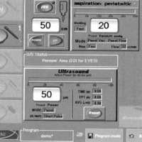 Figura 2. Parámetros de facoemulsificación tomados del monitor del simulador.