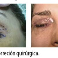 Figura 28. Correción quirúrgica.