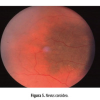Figura 5. Nevus coroideo.