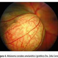 Figura 4. Melanoma coroideo amelanótico (gentileza Dra. Zelia Correa).	